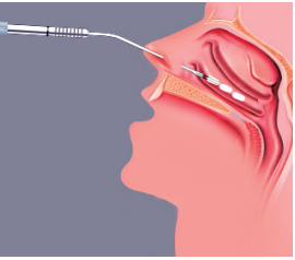 Биполярная радиохирургическая тканевая редукция (RaVoR) носовых раковин при помощи персональных электродов.